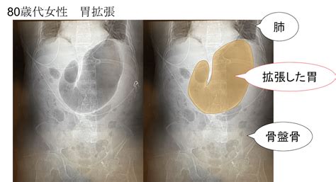 胃 位置|【CT画像あり】胃の場所を図で解説！痛みが出るの。